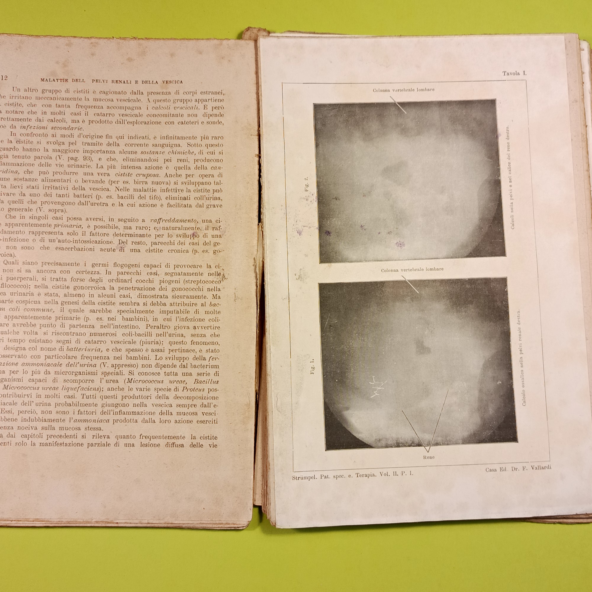 TRATTATO PATOLOGIA SPECIALE MEDICA E TERAPIA VOL II PARTE I - immagine 3